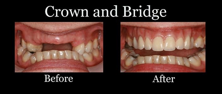 The Enigmatic Craftsmanship Behind Dental Bridges and Crowns, Implants & Restoration article from Shenandoah Dental Center