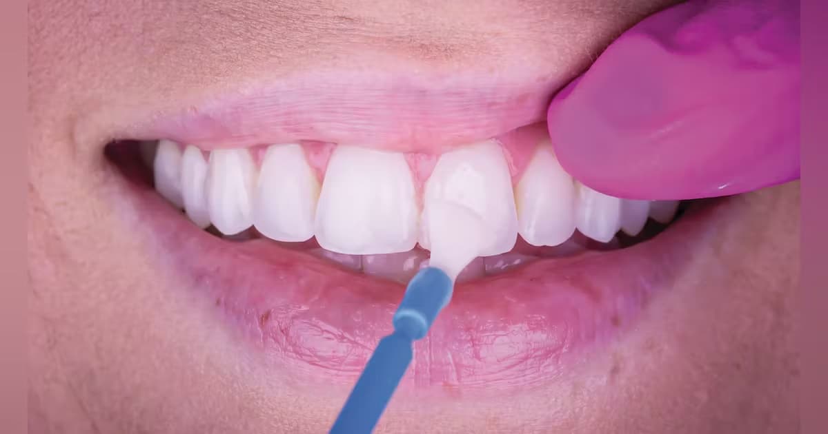 The Remarkable Benefits of Fluoride Varnish in Preventative Dental Care, Preventive article from Shenandoah Dental Center