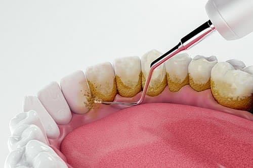 Unraveling the Mystery of Dental Plaque: A Microscopic Adventure, Preventive article from Shenandoah Dental Center